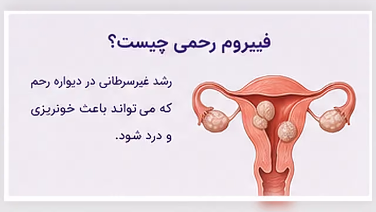 نمای آموزشی درباره فیبروم رحم