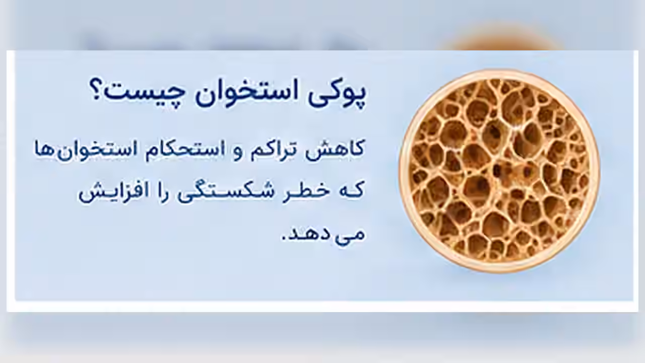 نمای آموزشی درباره پوکی استخوان